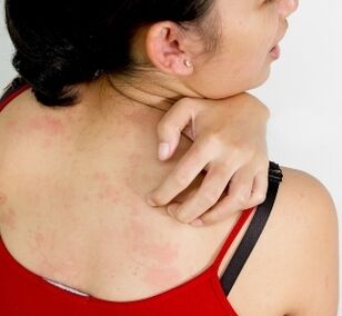 granulomas on the body - symptoms of the presence of parasites