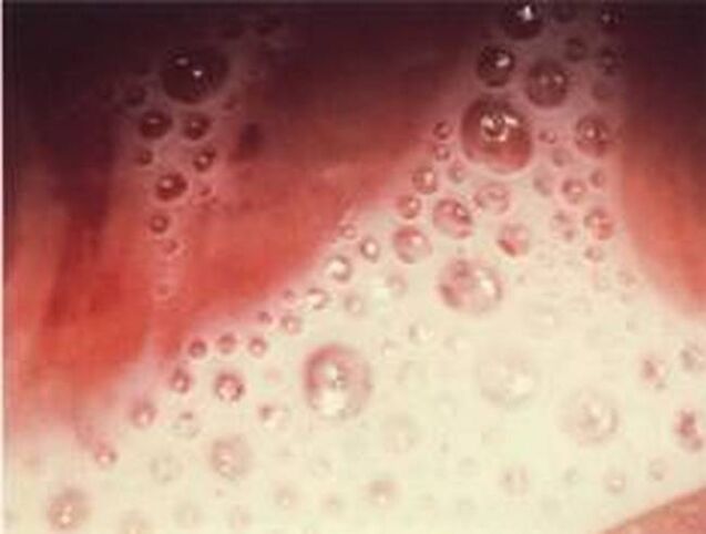 release of bubbles with protozoan parasites