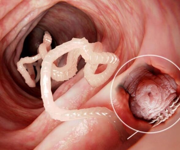 worms in human intestines photo 2