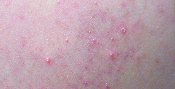 Rashes on the body can be a sign of helminthiasis